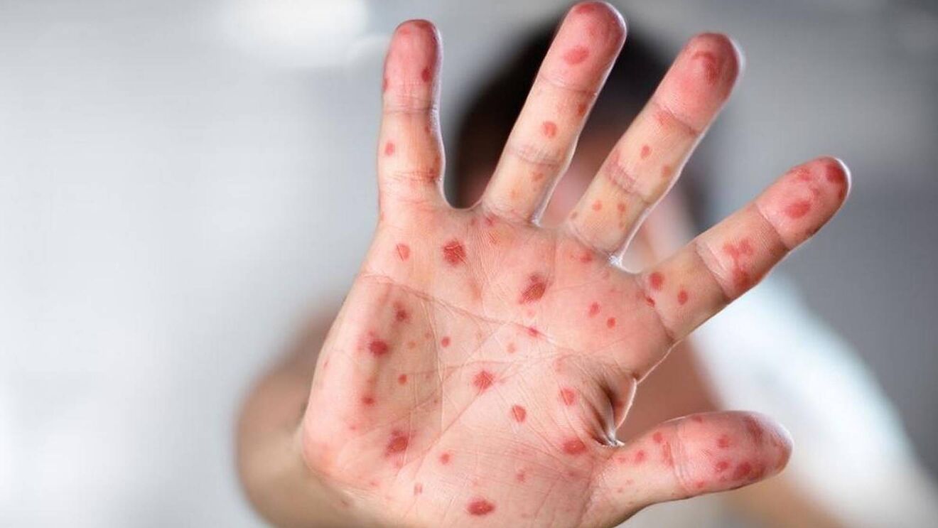 First confirmed case of Monkeypox reported in India