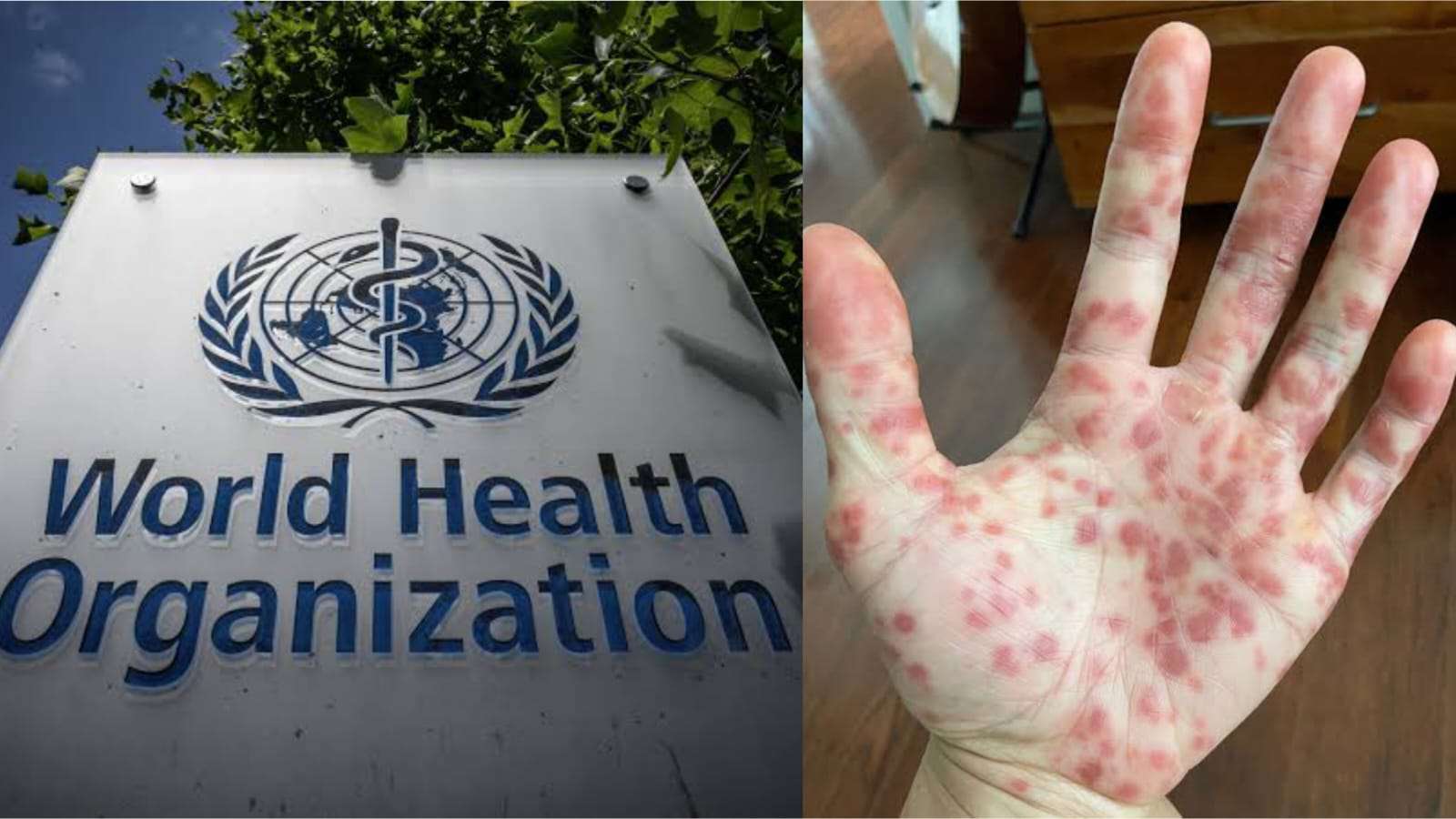 WHO to assist Pakistan to contain monkeypox